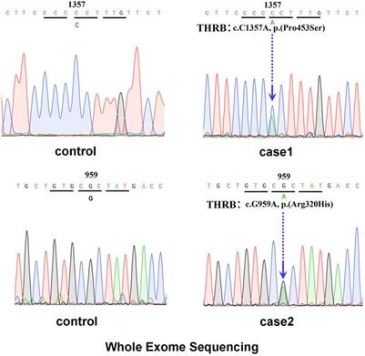 Resistance to thyroid hormone beta coexisting with papillary thyroid carcinoma—two case reports of a thyroid hormone receptor beta gene mutation and a literature review